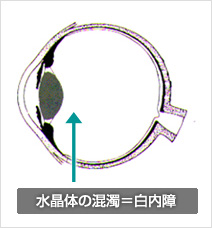 水晶体の混濁＝白内障