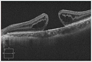 黄斑円孔の断面写真