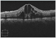 網膜中心静脈閉塞症による黄斑部の浮腫