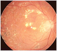 黄斑部の浮腫に脂質の沈着を伴っています