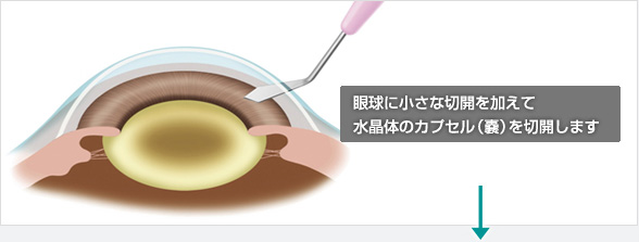 眼球に小さな切開を加えて水晶体のカプセル（嚢）を切開します